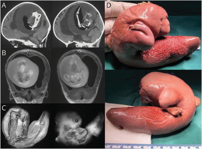 A 1 year old girl had her twin growing inside her brain. This is what it looked like.