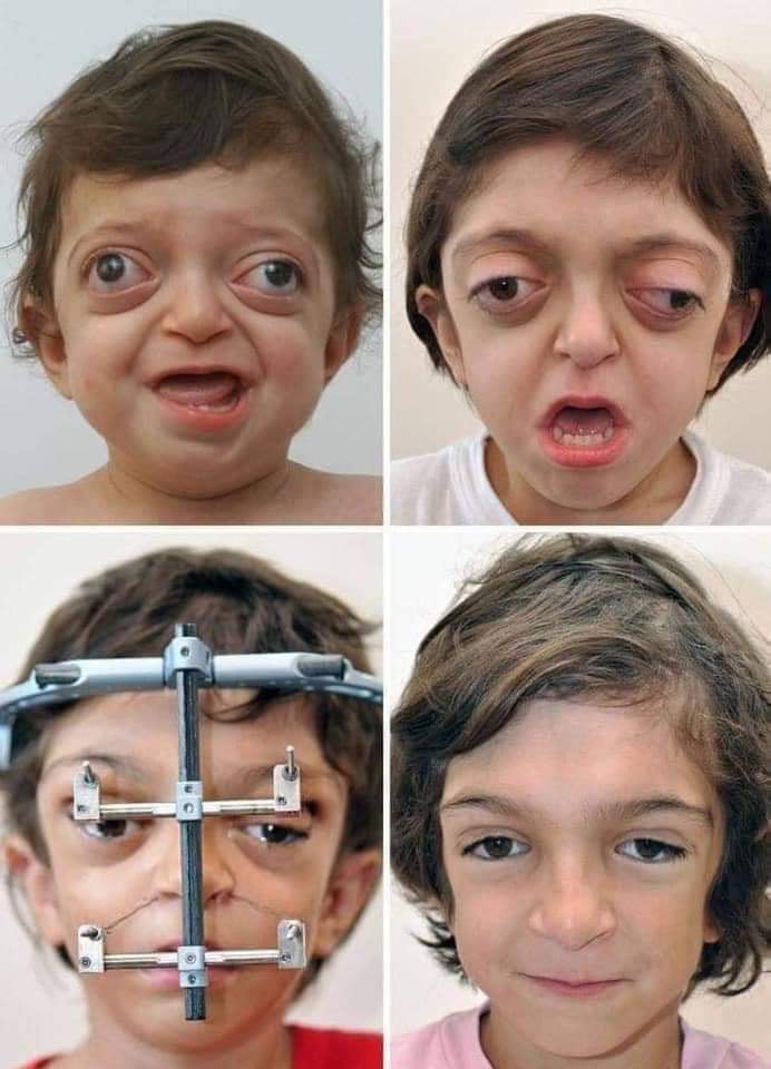 Little girl before and after facial reconstruction