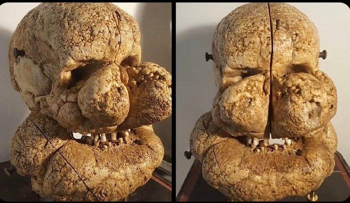 A skull of a man with Proteus syndrome, a rare condition characterized by overgrowth of bones, skin, muscles, fatty tissues, and blood and lymphatic vessels.