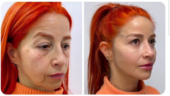 Now this is one of the best plastic surgery examples I've ever seen