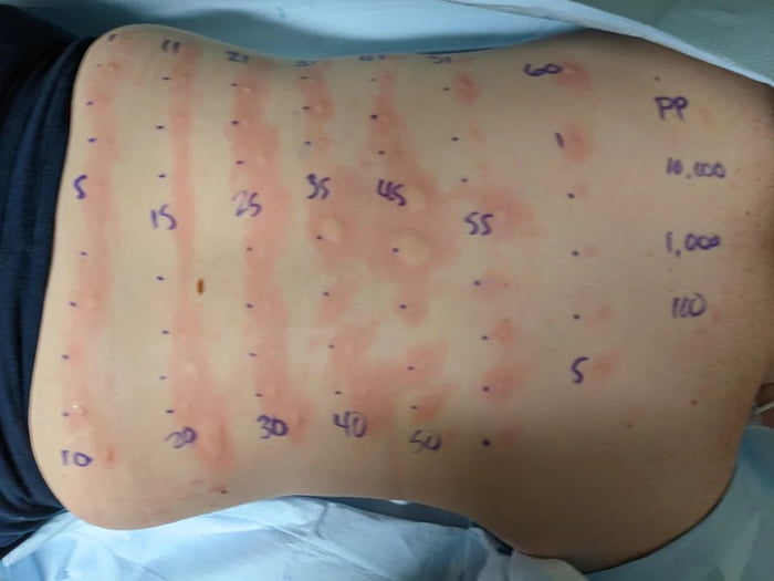 Of the 69 things they tested me for, I'm allergic to 60 of them.