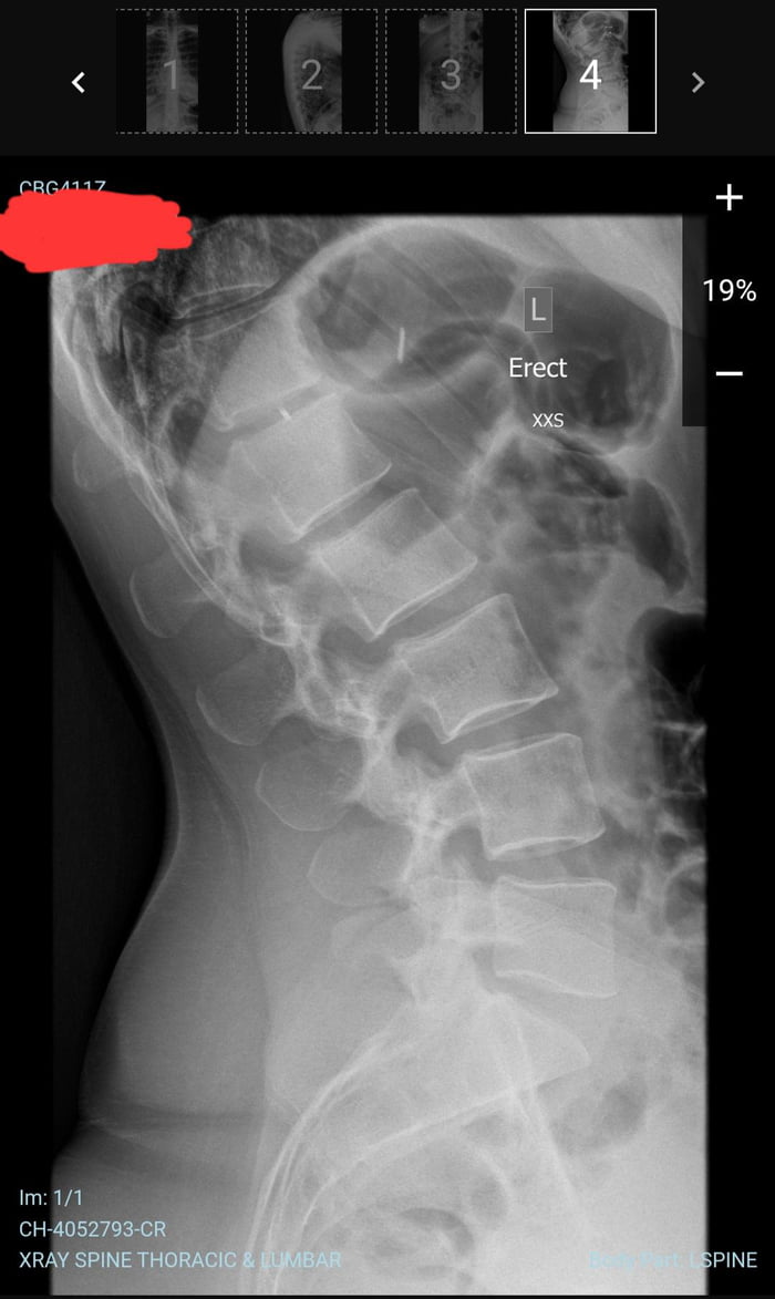 Got an xray because of back pain