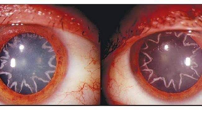 The eyes of an electrician after being zapped by 14,000 volts of electricity. His shoulder touched a live wire and the current passed through his entire body, including the optic nerve, which connects the eye to the brain. The effect was two bizarre