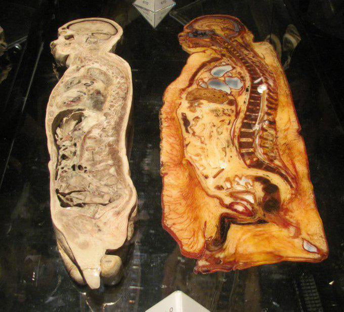 Cross section of two human males - one obese and the other fit.