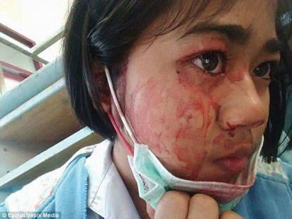 This woman has hematohidrosis, a rare condition where blood is excreted through the sweat glands