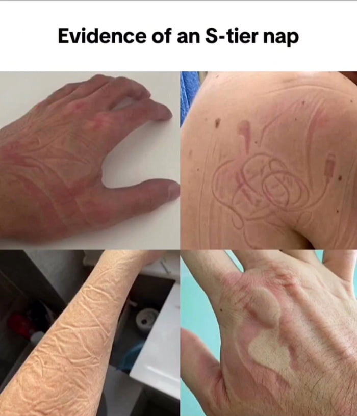This is too real. Why do naps hit different with the skin marks?