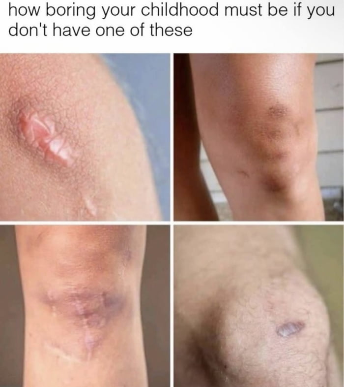 Childhood scars are badges of honor, telling tales of adventures and misadventures.