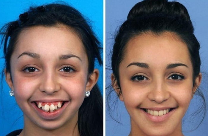 Jaw surgery drastically alters girl's facial look