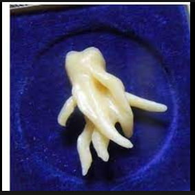 Apparently, this was someone's wisdom tooth:
