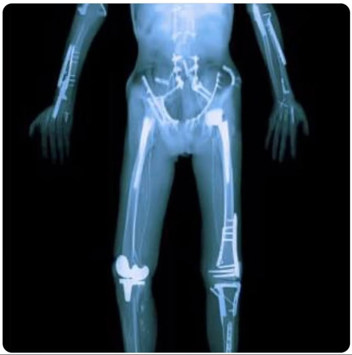 X-ray of extreme sport athlete Travis Pastrana