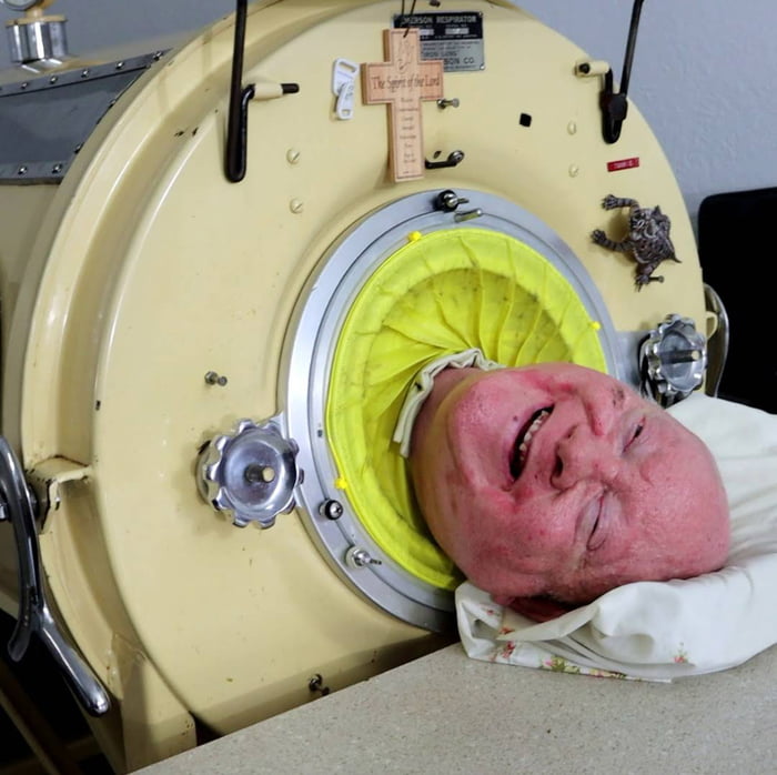 Paul Alexander, the polio victim that has lived in an iron lung for 70 years, has passed away. He was 78 years old.