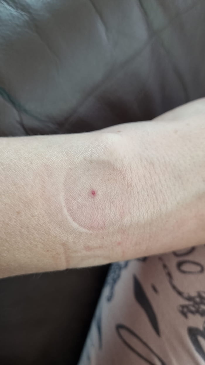 My wife got this mark in the middle from the samsung galaxy watch 6. Does anyone have the same experience?