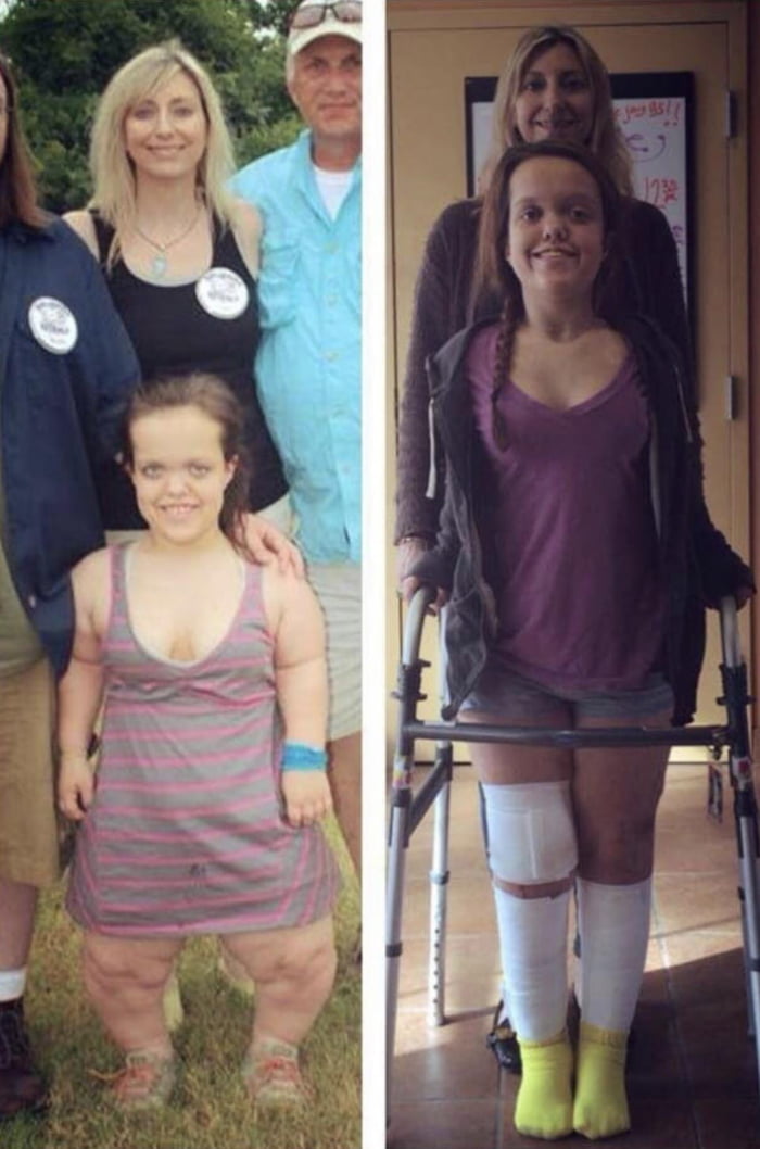 Before and After Limb Lengthening.