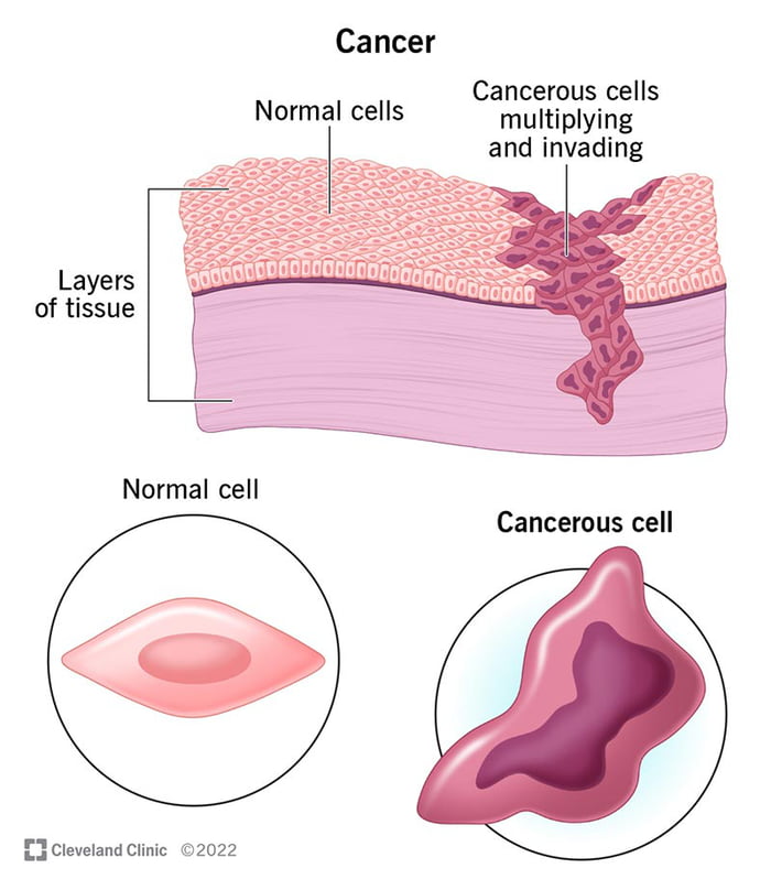 I just got diagnosed with cancer today. I don't know whether to be happy or sad.