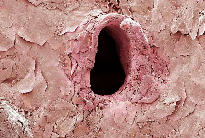 This is what a hole in the skin looks like after a needle punctures it, as observed under a scanning electron microscope.