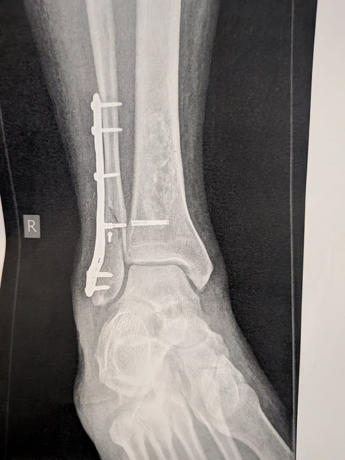 I'm not trying to do a Facebook thing, but I broke my ankle a couple weeks ago and I was surprised that I had to have surgery done and so much medal added. has anyone else dealt with this before?