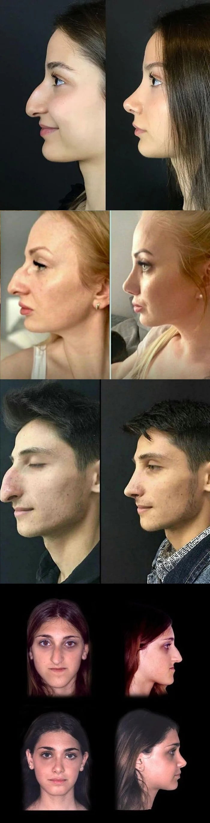 These rhinoplasty & jaw reduction surgeries (when done right) makes them a whole new person