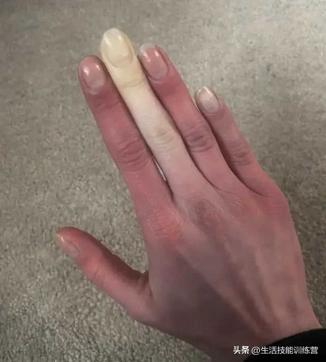 Raynaud's syndrome