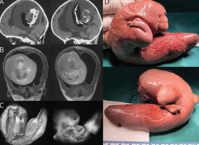 The one-year-old girl's twin was growing inside her brain and looked like this.
