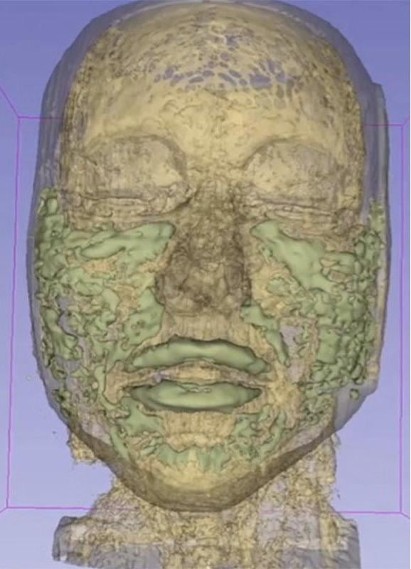 Scan of a face with years of dermal filler build up