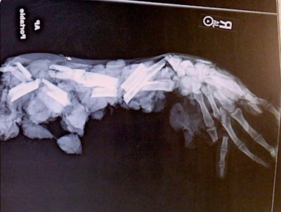 X-ray of a hand after a meat grinder accident..in case you thought you had a bad day