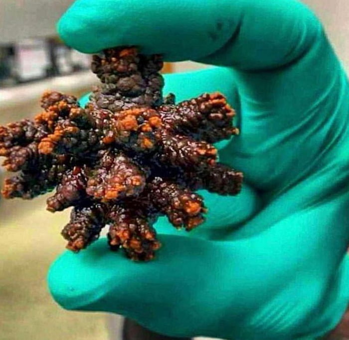 “Calcium Oxalate” stone removed from the bladder