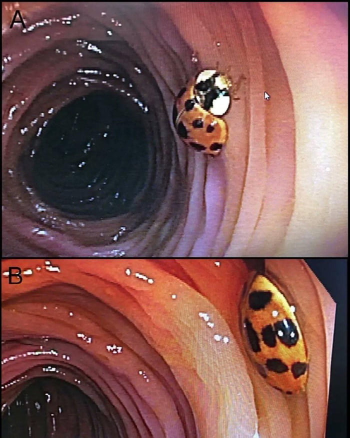 World's first case of an alive ladybug found in someone's colon during colonoscopy