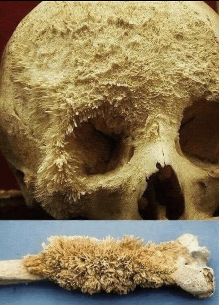 This is how bone cancer looks like. Perhaps one of the most painful conditions.