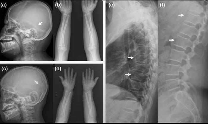 There is a mutation that causes bones to become 8 times denser than normal that allow people to walk away from car accidents without a single fracture but with a trade off of being unable to swim.