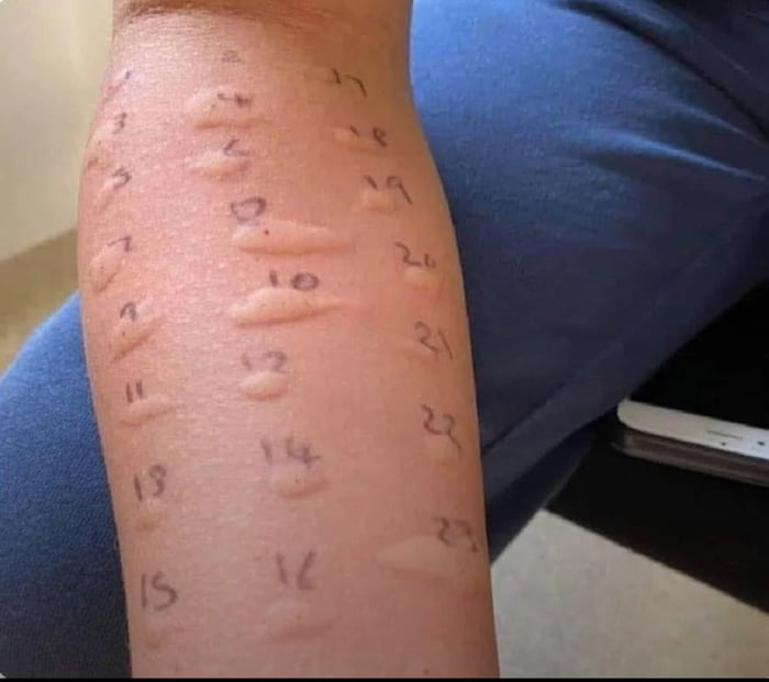 When you realize you are allergic to life