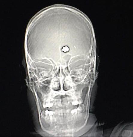 In the 80s patient “George” with severe OCD shot himself in the head attempting suicide. Rather than killing him, the bullet destroyed the part of his brain responsible for OCD.